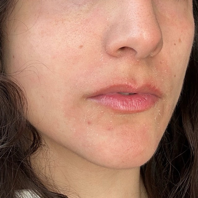 Close-up of a person's face with visible skin texture and irritation.